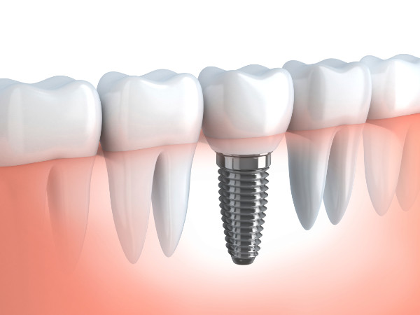 Dental Implants