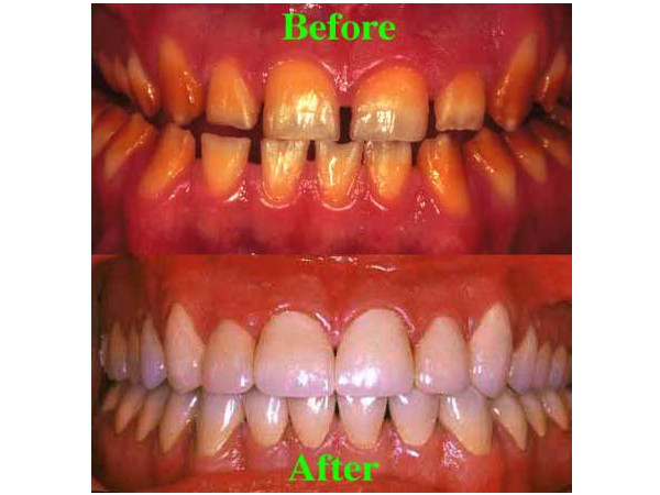 Dental Implants