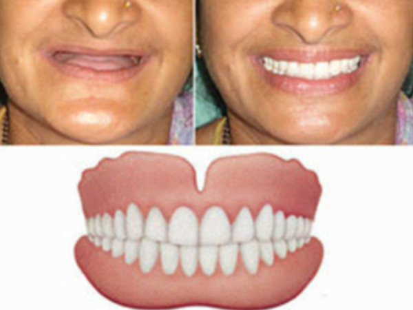 Complete Denture