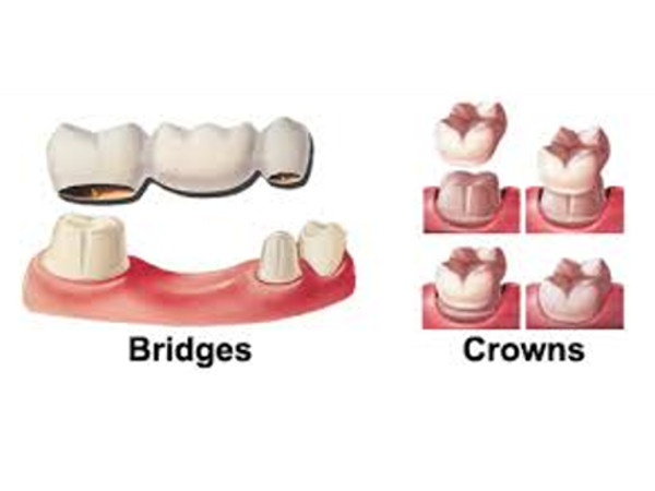 Crowns and Bridges