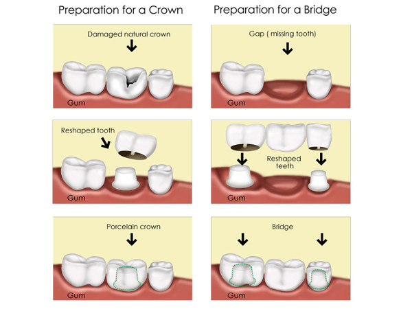 Crowns and Bridges