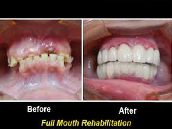 Full Mouth Rehabilitatiaon