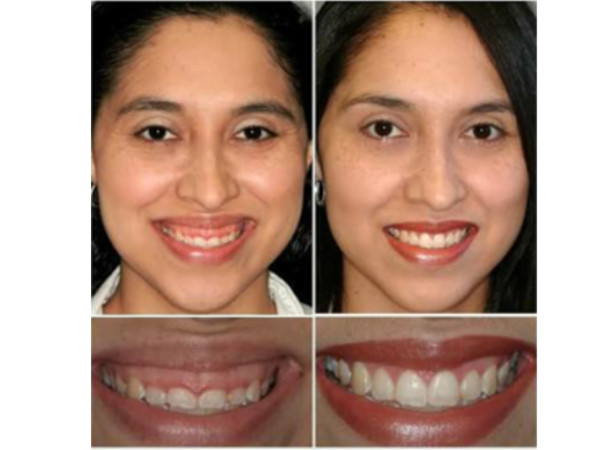 Smile Make Over