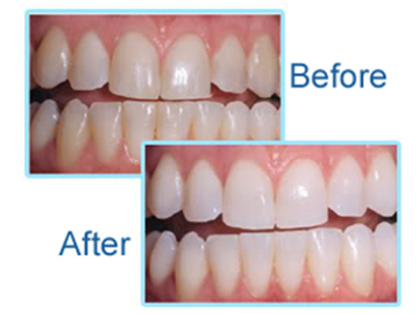 Teeth Whitening