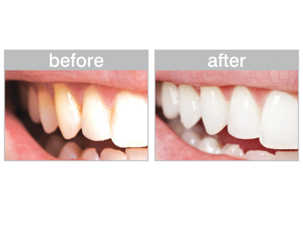 Teeth Whitening