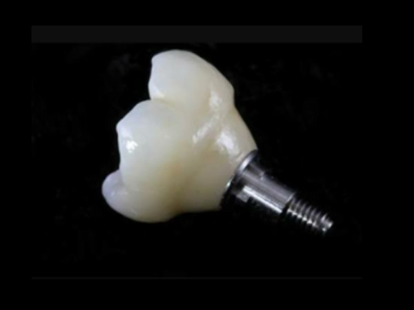 Zirconia Crowns