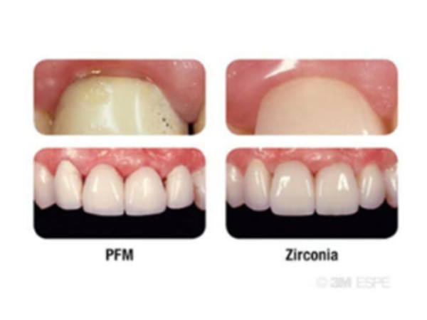 Zirconia Crowns