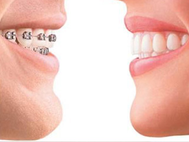 Clear Aligners